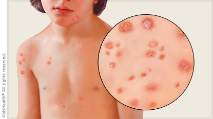 Los casos de la varicela se duplican en un solo año